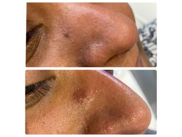 Skin tag removal clinic Goodmayes