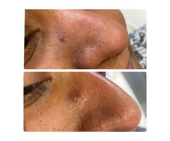 Skin tag removal clinic Goodmayes