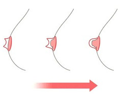 Inverted nipple suckers