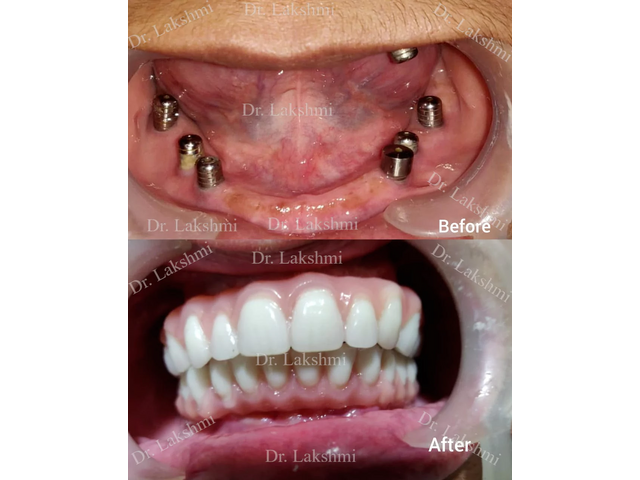 Dental Implants in Bangalore - Perfect Smile Super speciality