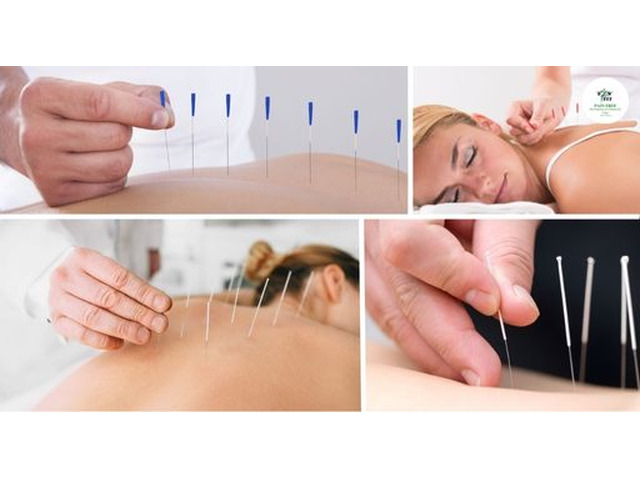 Best Acupuncture Therapy Near Me for Natural Pain Relief