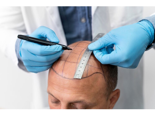 Affordable Hair Transplant in Allahabad – Only at Hair Aesthetica