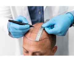 Affordable Hair Transplant in Allahabad – Only at Hair Aesthetica