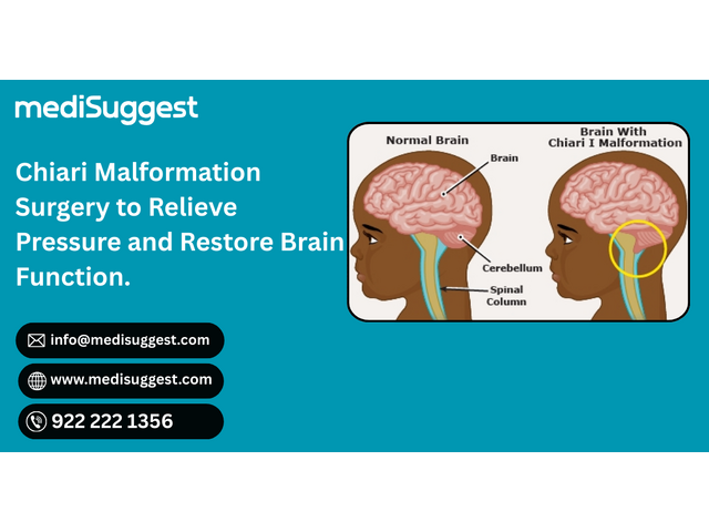 Expert Chiari Malformation Surgery Near Bhayander