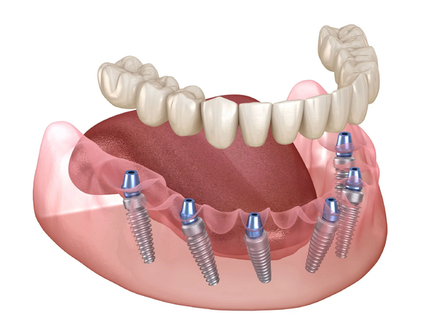 Best Full Mouth Dental Implant Surgeon: Restore Your Smile with Expert Precision