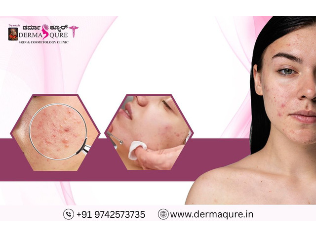 Acne Scar Treatment in Bangalore at Dermaqure