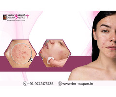 Acne Scar Treatment in Bangalore at Dermaqure