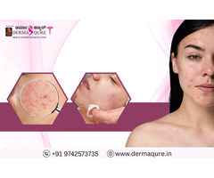 Acne Scar Treatment in Bangalore at Dermaqure
