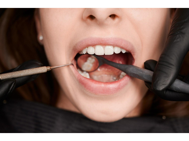 Get Tooth-Colored Fillings for a Perfect Smile in the USA